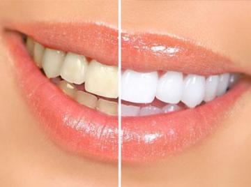 Miami Cosmetic Dentistry for Professional Teeth Whitening