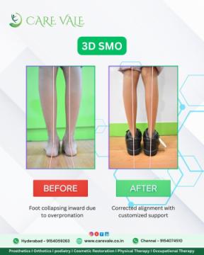 Best Artificial Leg in Hyderabad | CareVale Prosthetics