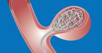 Expert Coil Embolization Procedure in India