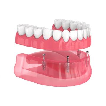 Get a New Smile with Free Dental Implants in Florida