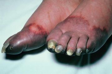 Gangrene Treatment in Ludhiana – Dr. Luv Luthra Get expert care f